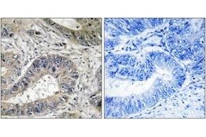 Immunohistochemistry analysis of paraffin-embedded human colon carcinoma tissue, using ERN2 Antibody. (ERN2 Antikörper  (AA 841-890))