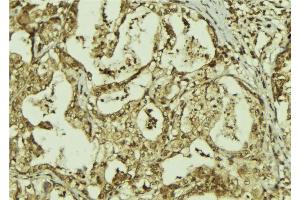 ABIN6273306 at 1/100 staining Human breast cancer tissue by IHC-P.