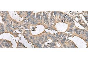 Immunohistochemistry of paraffin-embedded Human colorectal cancer tissue using MRPL42 Polyclonal Antibody at dilution of 1:65(x200)
