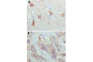 Immunohistochemical analysis of paraffin-embedded human brain (A) and breast carcinoma (B), showing cytoplasmic and membrane localization using PAWR monoclonal antibody, clone 3G9H7  with DAB staining. (PAWR Antikörper)