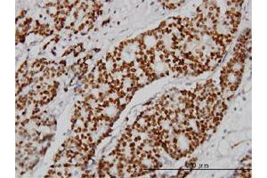 Immunohistochemistry (Formalin-fixed Paraffin-embedded Sections) (IHC (fp)) image for anti-Progesterone Receptor (PGR) (AA 1-110) antibody (ABIN562204)