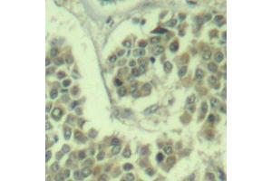 Immunohistochemistry of paraffin-embedded human breast carcinoma using Phospho-eIF2α-S49 antibody (ABIN2987986). (EIF2S1 Antikörper  (pSer49))