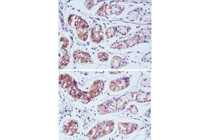 Immunohistochemical analysis of paraffin-embedded human stomach carcinoma tissue using PGA5 monoclonal antobody, clone 2C1  with DAB staining. (PGA5 Antikörper)