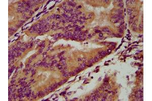 IHC image of ABIN7166221 diluted at 1:200 and staining in paraffin-embedded human endometrial cancer performed on a Leica BondTM system. (IGSF9 Antikörper  (AA 132-298))
