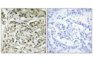 Immunohistochemistry analysis of paraffin-embedded human breast carcinoma tissue, using TAF1 antibody. (TAF1 Antikörper)