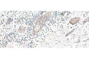 Immunohistochemistry of paraffin-embedded Human esophagus cancer tissue using ARL2BP Polyclonal Antibody at dilution of 1:50(x200)