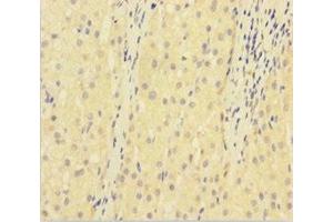 Immunohistochemistry of paraffin-embedded human liver cancer using ABIN7175384 at dilution of 1:100 (VEGFR2/CD309 Antikörper  (AA 20-764))