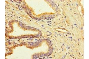 Immunohistochemistry of paraffin-embedded human prostate cancer using ABIN7147948 at dilution of 1:100 (CLUAP1 Antikörper  (AA 161-413))
