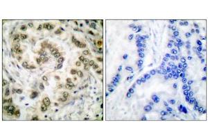 Immunohistochemical analysis of paraffin-embedded human lung carcinoma tissue, using E2F4 antibody (ABIN5976385). (E2F4 Antikörper  (Internal Region))