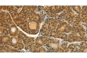 Immunohistochemistry of paraffin-embedded Human thyroid cancer tissue using SOCS5 Polyclonal Antibody at dilution 1:35