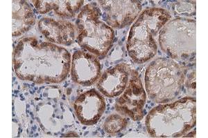 Immunohistochemical staining of paraffin-embedded Carcinoma of Human kidney tissue using anti-SDR9C7 mouse monoclonal antibody. (SDR9C7 Antikörper)