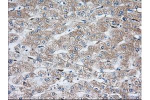 Immunohistochemical staining of paraffin-embedded Carcinoma of Human thyroid tissue using anti-TBXAS1 mouse monoclonal antibody.