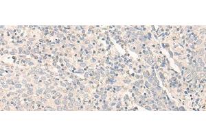 Immunohistochemistry of paraffin-embedded Human cervical cancer tissue using RADIL Polyclonal Antibody at dilution of 1:40(x200)