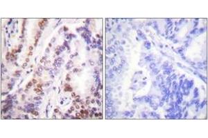 Immunohistochemistry analysis of paraffin-embedded human lung carcinoma tissue, using HDAC9 Antibody. (HDAC9 Antikörper  (AA 1017-1066))