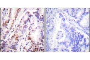 Immunohistochemistry analysis of paraffin-embedded human lung carcinoma tissue, using HDAC9 Antibody.