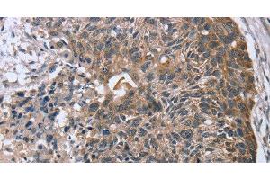 Immunohistochemistry of paraffin-embedded Human esophagus cancer using RASSF7 Polyclonal Antibody at dilution of 1:45 (RASSF7 Antikörper)