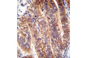 Immunohistochemistry analysis in formalin fixed and paraffin embedded human uterus tissue reacted with NUMB Antibody (N-term) followed by peroxidase conjugation of the secondary antibody and DAB staining.