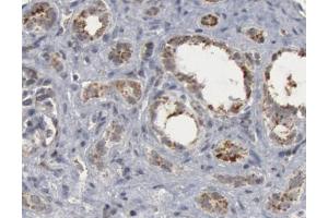 1/50 dilution staining Caspase 9 in human lung carcinoma by Immunohistochemistry (Caspase 9 Antikörper  (Cleaved-Asp330))