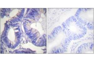 Immunohistochemistry analysis of paraffin-embedded human colon carcinoma tissue, using NCK2 Antibody. (NCK2 Antikörper  (AA 331-380))