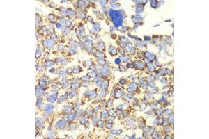 Immunohistochemistry of paraffin-embedded human esophageal cancer using GLUD2 antibody. (GLUD2 Antikörper)