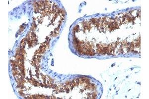 Formalin-fixed, paraffin-embedded human Testicular Carcinoma stained with MVP Monoclonal Antibody (1032). (MVP Antikörper)