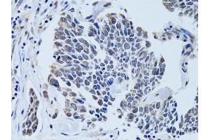 Immunohistochemistry of paraffin-embedded human lung cancer using SIN3A antibody (ABIN6293567) at dilution of 1:100 (40x lens). (SIN3A Antikörper)
