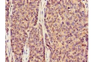 Immunohistochemistry of paraffin-embedded human ovarian cancer using ABIN7170002 at dilution of 1:100 (GLUT1 Antikörper  (AA 263-458))
