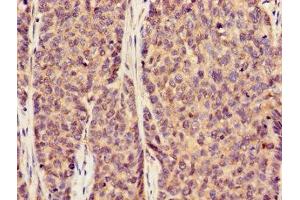 Immunohistochemistry of paraffin-embedded human ovarian cancer using ABIN7170002 at dilution of 1:100 (GLUT1 Antikörper  (AA 263-458))