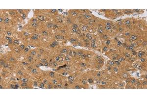 Immunohistochemistry of paraffin-embedded Human liver cancer tissue using KCNJ15 Polyclonal Antibody at dilution 1:40 (KCNJ15 Antikörper)