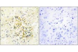 Immunohistochemistry analysis of paraffin-embedded human prostate tissue, using TMEPA Antibody. (TMEPA (AA 101-150) Antikörper)