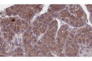 ABIN6273973 at 1/100 staining Human liver cancer tissue by IHC-P. (OR1L3 Antikörper  (C-Term))