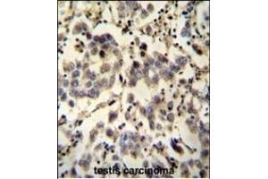 C6orf58 antibody (Center) (ABIN653979 and ABIN2843925) immunohistochemistry analysis in formalin fixed and paraffin embedded human testis carcinoma followed by peroxidase conjugation of the secondary antibody and DAB staining. (C6ORF58 Antikörper  (AA 205-233))