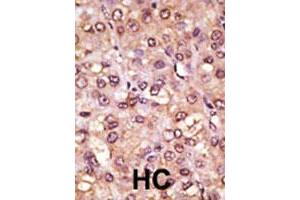 Formalin-fixed and paraffin-embedded human hepatocellular carcinoma tissue reacted with ASCL1 polyclonal antibody , which was peroxidase-conjugated to the secondary antibody, followed by AEC staining. (ASCL1 Antikörper  (C-Term))
