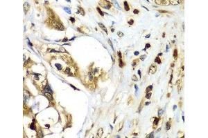 Immunohistochemistry of paraffin-embedded Human liver cancer using TMOD4 Polyclonal Antibody at dilution of 1:100 (40x lens). (Tropomodulin 4 Antikörper)