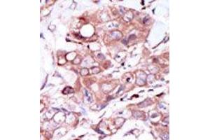 Formalin-fixed and paraffin-embedded human cancer tissue reacted with the primary antibody, which was peroxidase-conjugated to the secondary antibody, followed by DAB staining. (ERBB4 Antikörper  (C-Term))