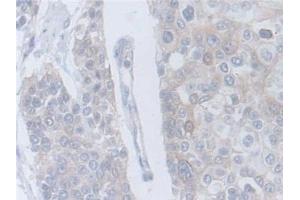 Detection of CRLF1 in Human Prostate cancer Tissue using Polyclonal Antibody to Cytokine Receptor Like Factor 1 (CRLF1) (CRLF1 Antikörper  (AA 138-422))