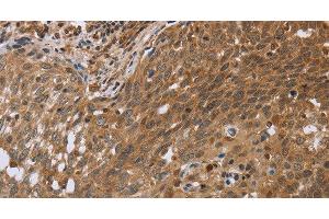 Immunohistochemistry of paraffin-embedded Human cervical cancer using NDUFS2 Polyclonal Antibody at dilution of 1:35 (NDUFS2 Antikörper)