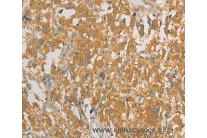 Immunohistochemistry of Human liver cancer using PRPSAP1 Polyclonal Antibody at dilution of 1:80 (PRPSAP1 Antikörper)