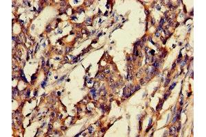 Immunohistochemistry of paraffin-embedded human gastric cancer using ABIN7153675 at dilution of 1:100 (Gastrin-Releasing Peptide Antikörper  (AA 31-98))
