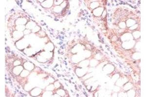 Immunohistochemistry of paraffin-embedded human colon cancer using ABIN7147238 at dilution of 1:100 (CDKN2AIPNL Antikörper  (N-Term))
