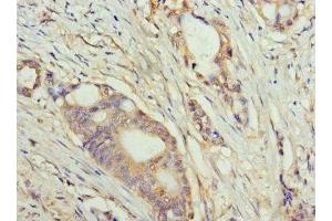 Immunohistochemistry of paraffin-embedded human colon cancer using ABIN7159633 at dilution of 1:100 (TET1 Antikörper  (AA 1700-1800))