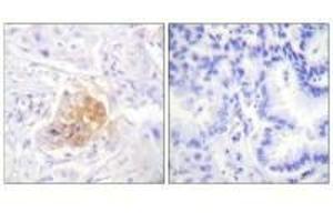 Immunohistochemistry analysis of paraffin-embedded human lung carcinoma tissue using IL-2Rβ/CD122 (Ab-364) antibody. (IL2 Receptor beta Antikörper  (Tyr364))