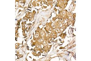 Immunohistochemistry of paraffin-embedded human breast cancer using β-Catenin Rabbit mAb (ABIN7266138) at dilution of 1:50 (40x lens). (CTNNB1 Antikörper)