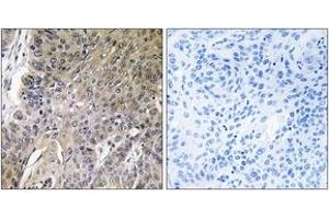 Immunohistochemistry analysis of paraffin-embedded human lung carcinoma tissue, using ARSG Antibody.