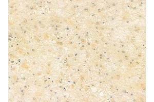 ABIN6257606 and ABIN6275142 at 1/100 staining human astrocytoma by IHC-P. (IFI16 Antikörper  (C-Term))