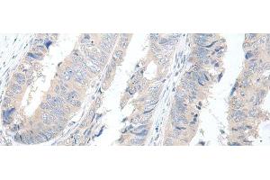 Immunohistochemistry of paraffin-embedded Human colorectal cancer tissue using GBA2 Polyclonal Antibody at dilution of 1:55(x200) (GBA2 Antikörper)