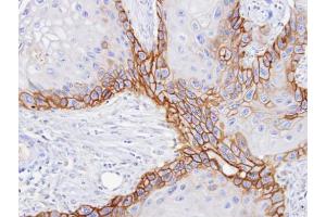 IHC-P Image Immunohistochemical analysis of paraffin-embedded SCC15 xenograft, using CD98, antibody at 1:100 dilution. (SLC3A2 Antikörper)
