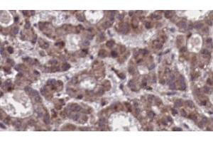 ABIN6273910 at 1/100 staining Human liver cancer tissue by IHC-P. (SSTR5 Antikörper  (Internal Region))