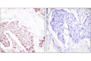 Immunohistochemistry analysis of paraffin-embedded human breast carcinoma, using Akt (Phospho-Ser124) Antibody.