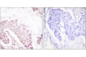 Immunohistochemistry analysis of paraffin-embedded human breast carcinoma, using Akt (Phospho-Ser124) Antibody. (AKT1 Antikörper  (pSer124))